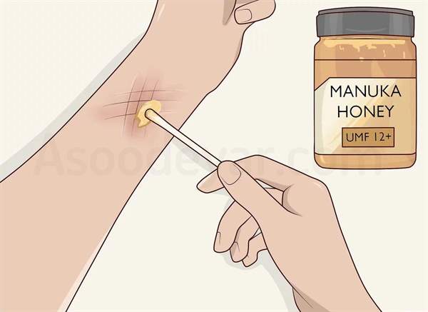 عسل برای درمان زخم بستر