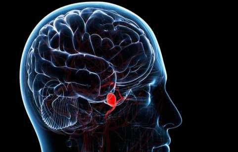 آنوریسم مغزی چیست؟ علائم، انواع، تشخیص و درمان آن چگونه است؟