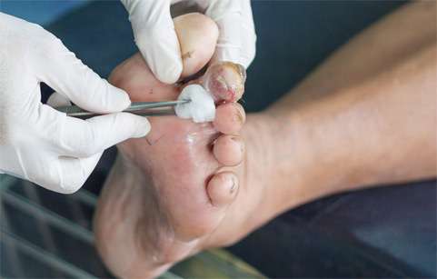 عفونت یا زخم پای دیابتی چیست؟